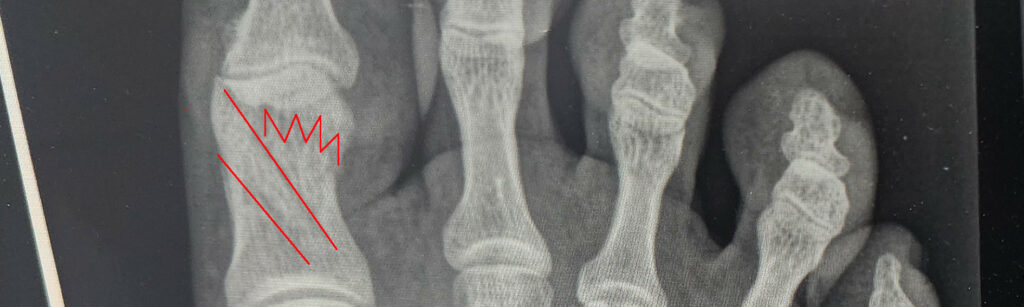 Highlighted version of the 'NICE!' fracture.