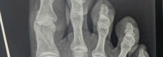 Fracture of my right big toe in several places.