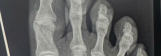 Fracture of my right big toe in several places.